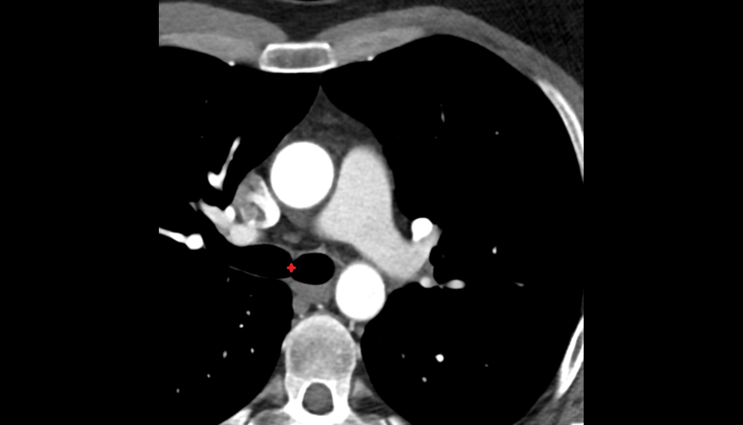 Tracheal bifurcation CT axial image -img-00000-00000_00001