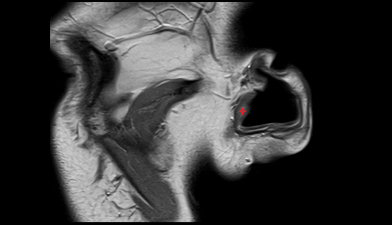 Tragus of ear MRI image