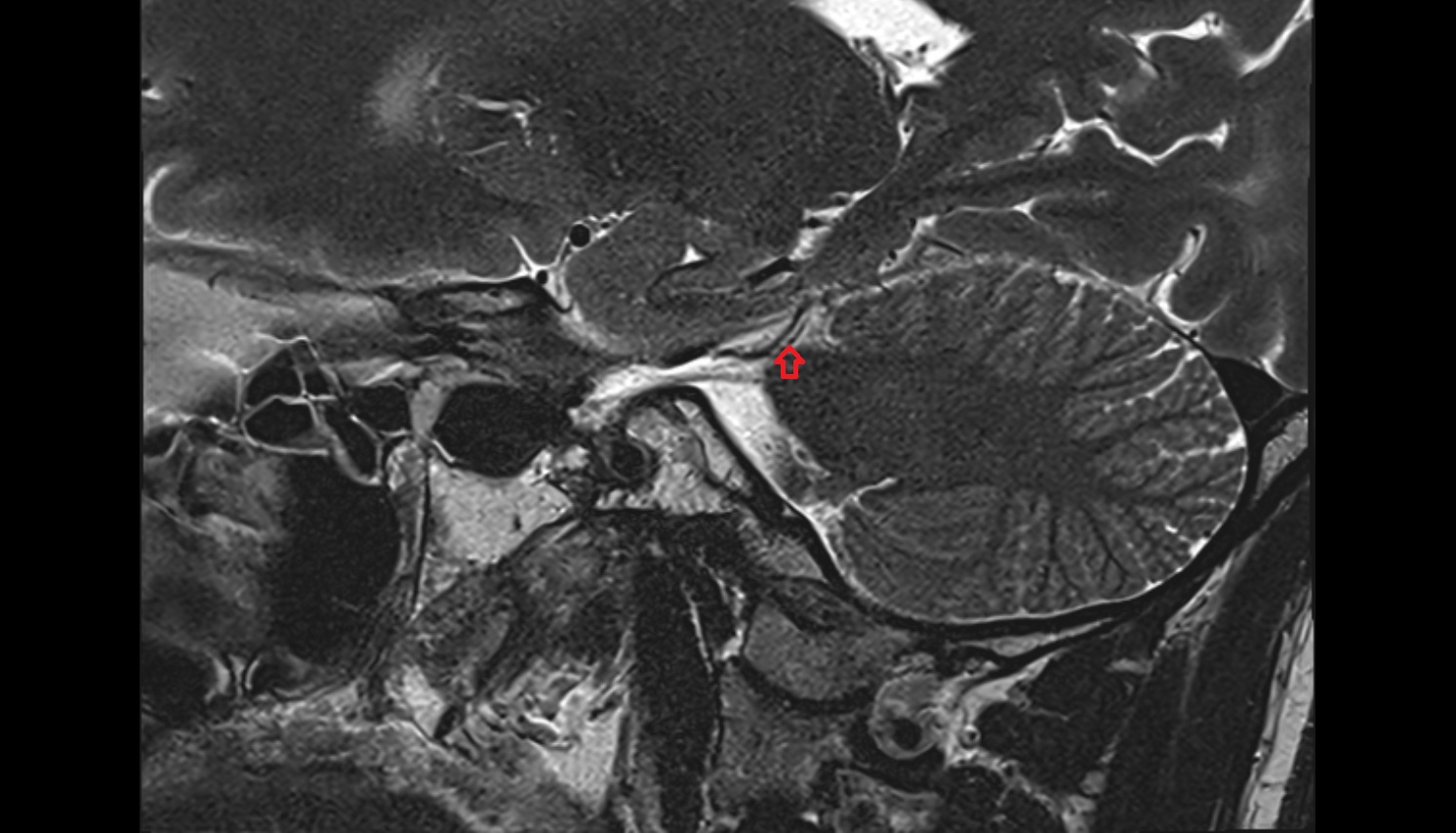 Transverse Pontine Vein  mri sag  image -img-00000-00000
