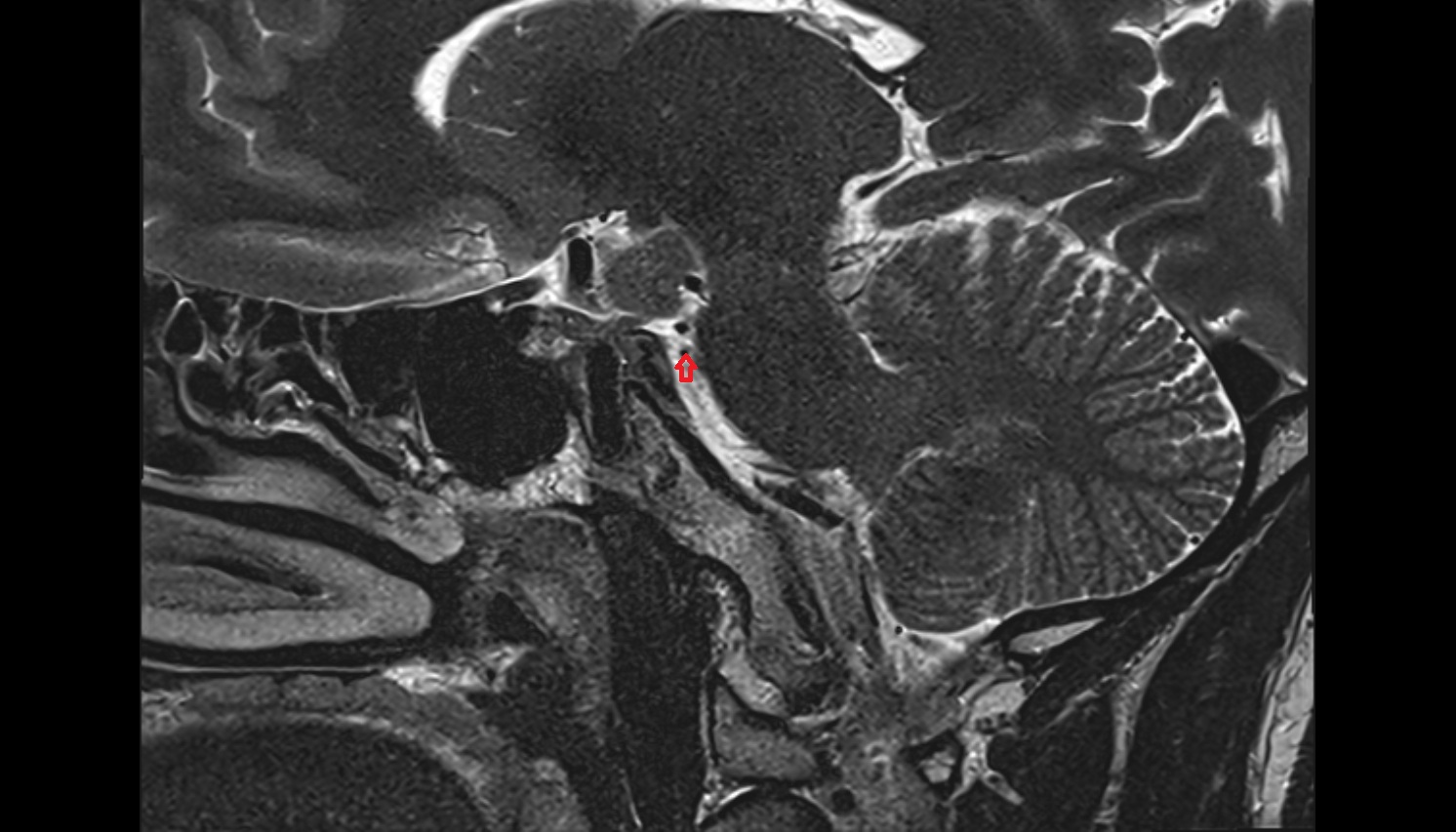 Transverse Pontine Vein  mri sag  image -img-00000-00000_00001