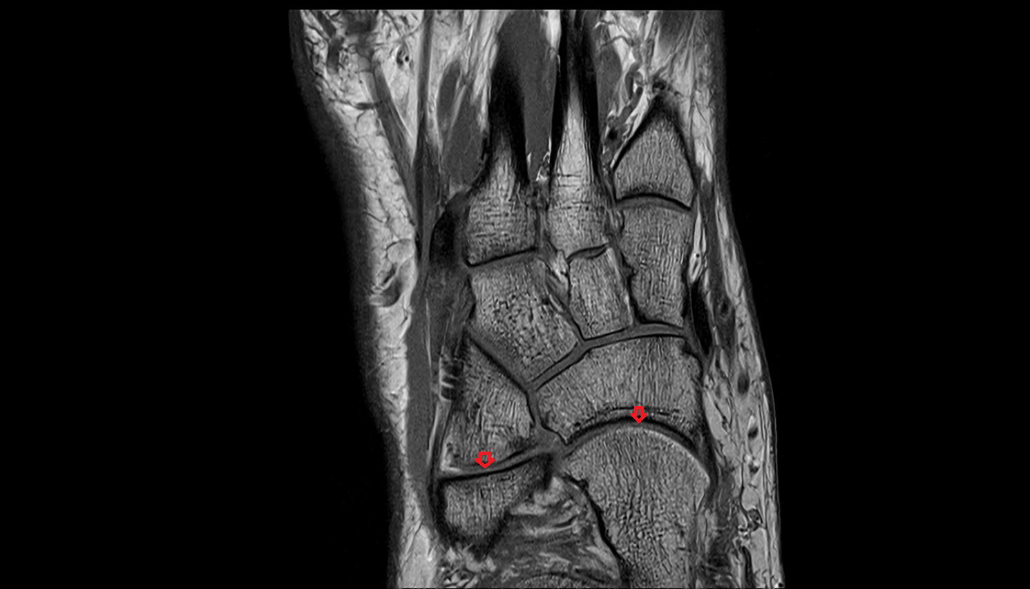 Transverse Tarsal Joint coronal cross sectional anatomy 3T MRI AI enhanced radiology image-img-00000-00000
