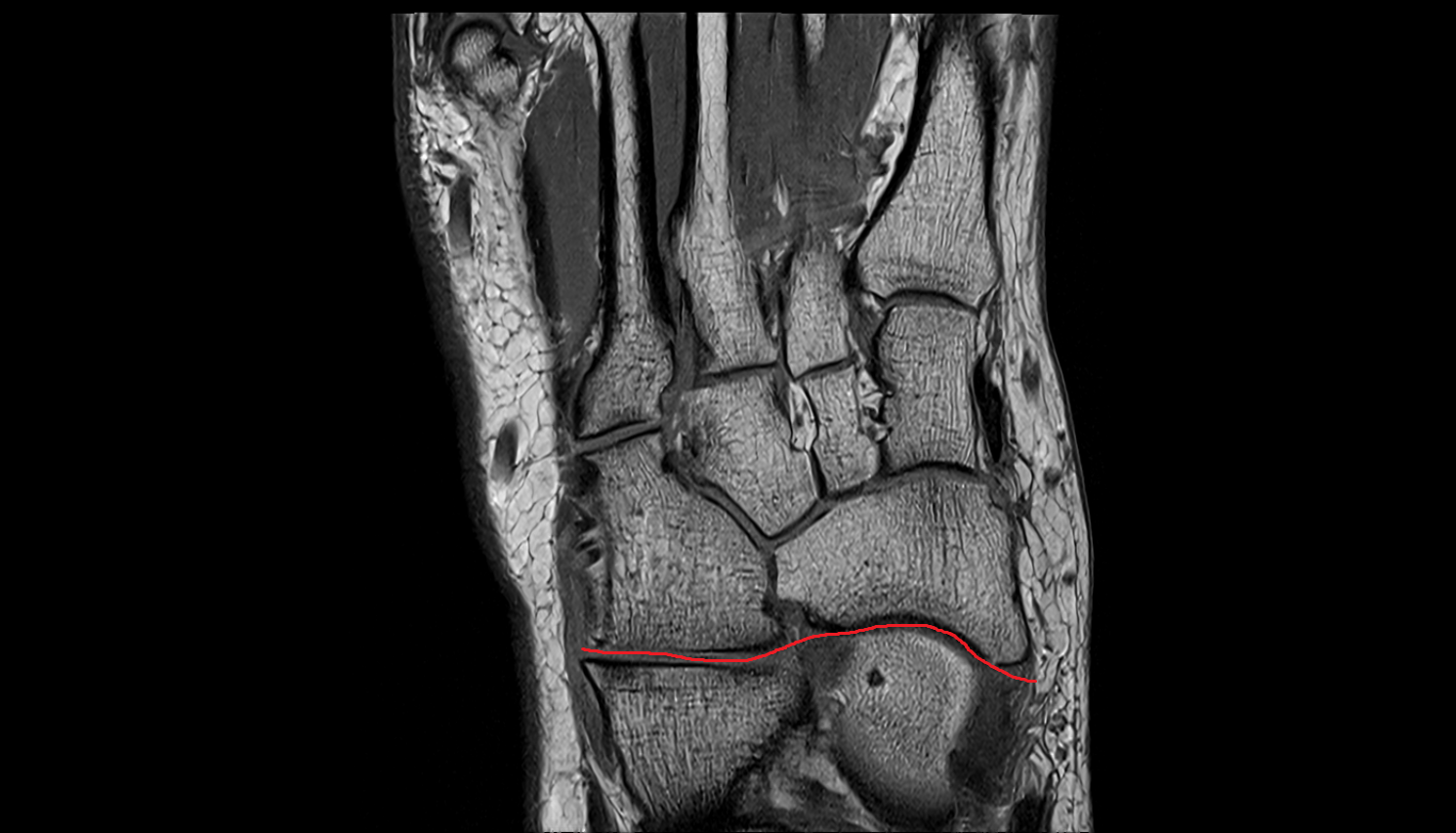Transverse Tarsal Joint coronal cross sectional anatomy 3T MRI AI enhanced radiology image-img-00000-00000_00001