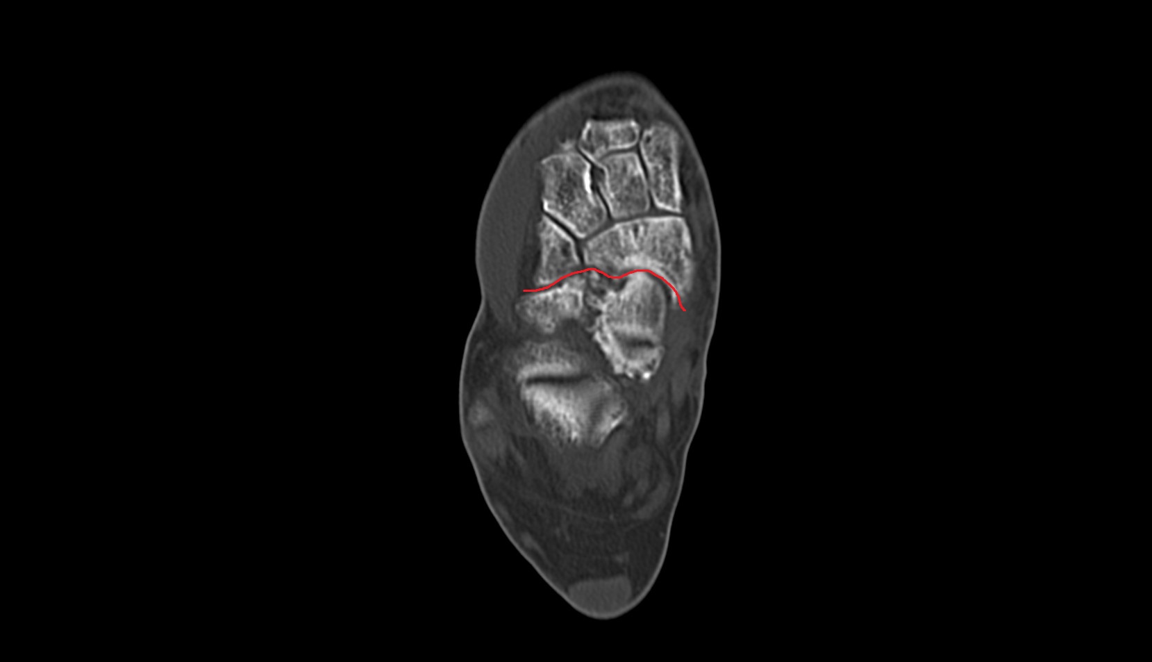 Transverse Tarsal Joint ct axial
