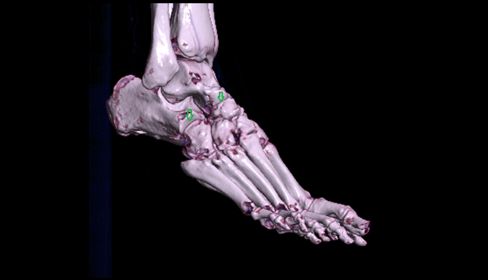 Transverse Tarsal Joint ct ver image