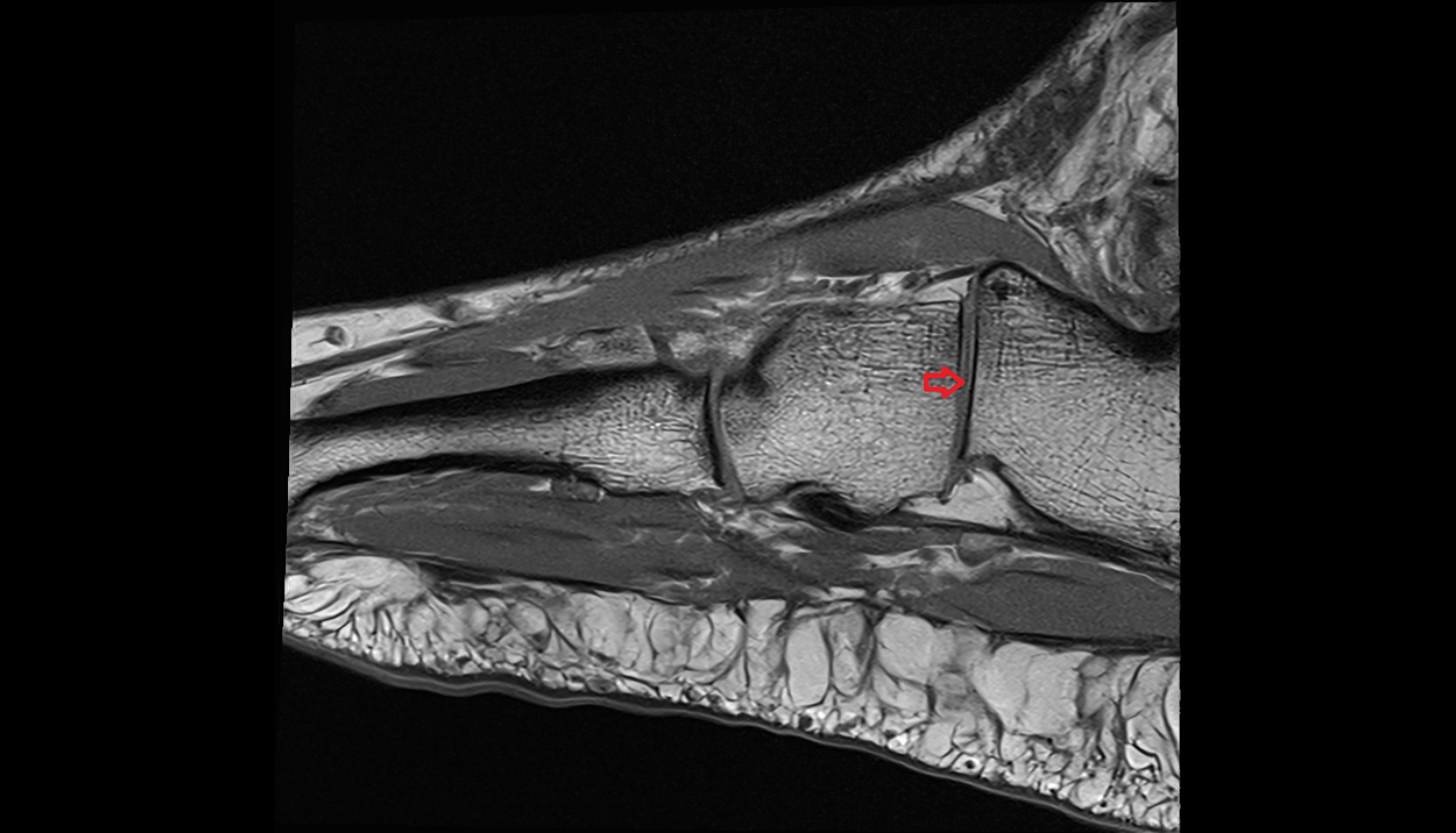 Transverse Tarsal Joint sagittal cross sectional anatomy 3T MRI AI enhanced radiology image-img-00000-00000