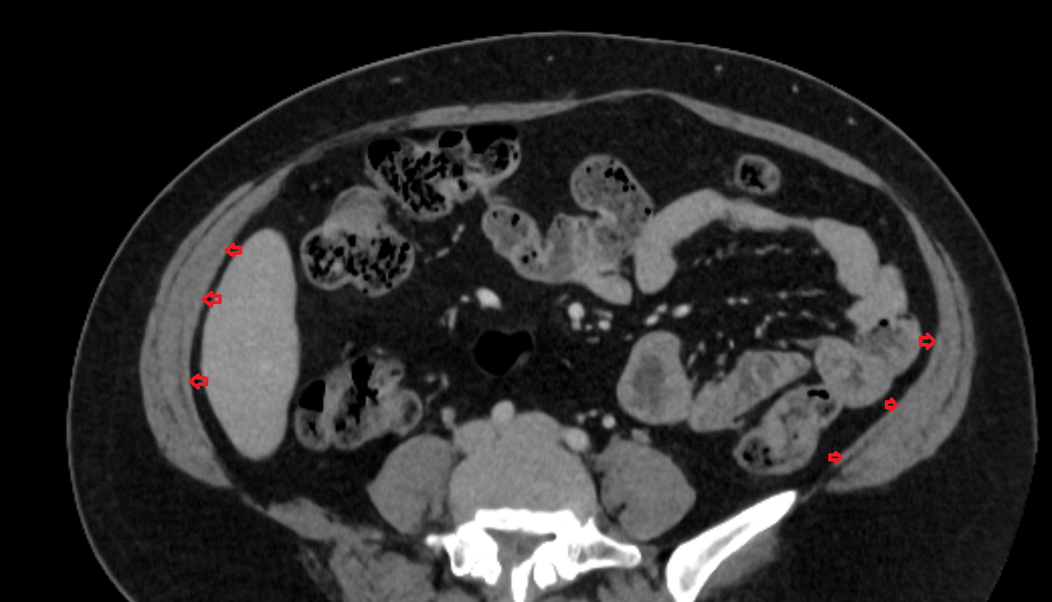 Transverse abdominal muscle CT  anatomy  Location and Imaging Appearance  -img-00000-00000