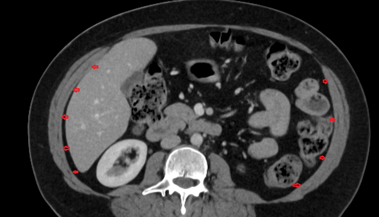 Transverse abdominal muscle CT  anatomy  Location and Imaging Appearance  -img-00000-00000_00001