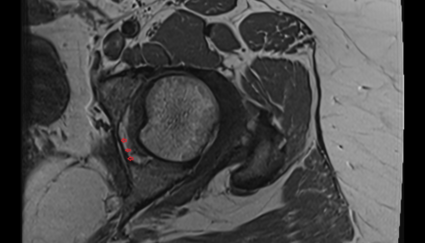 Transverse acetabular ligament  MRI axial  anatomy image-img-00000-00000