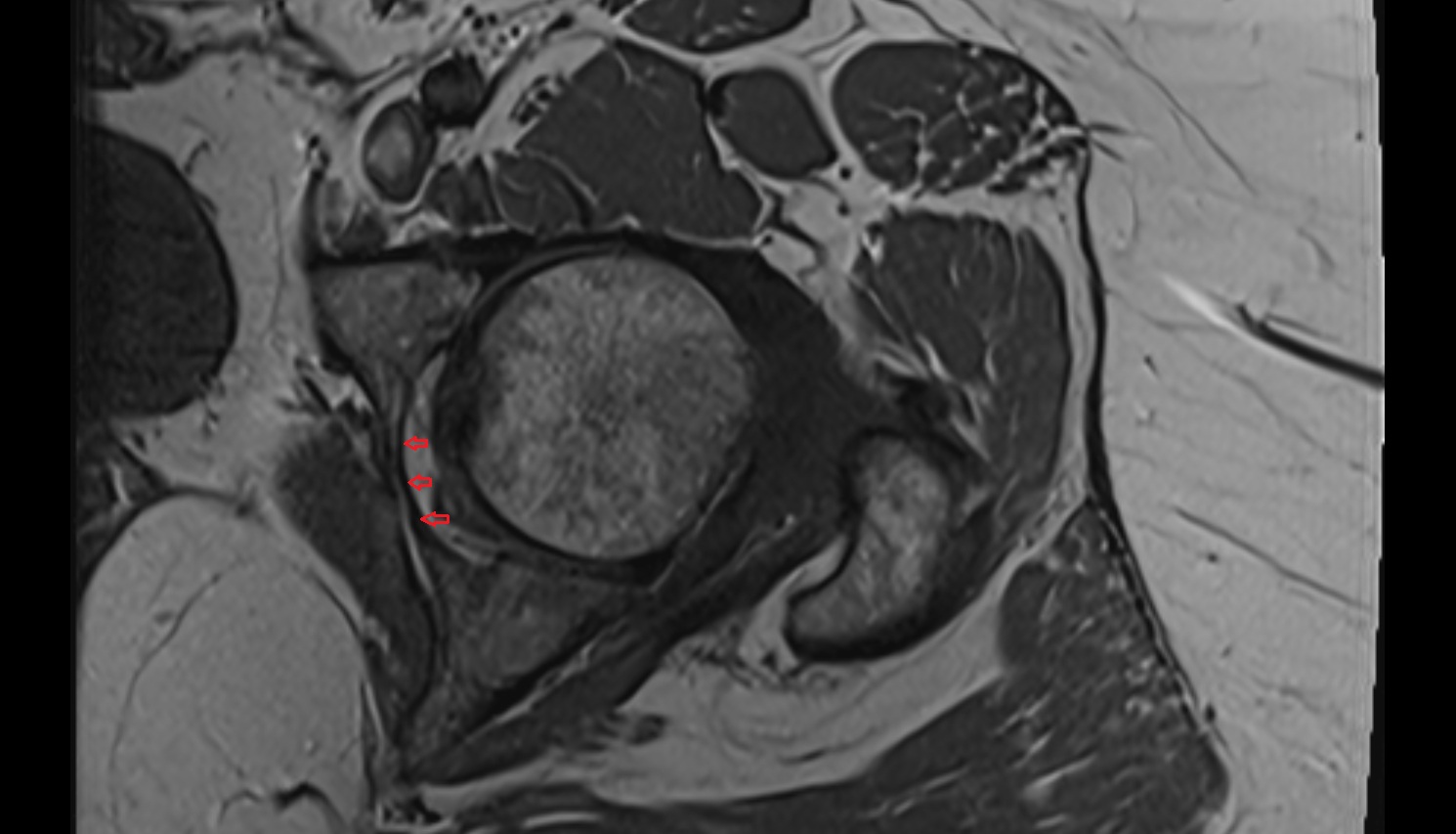 Transverse acetabular ligament  MRI axial  anatomy image-img-00000-00000_00001