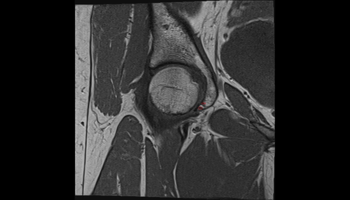 Transverse acetabular ligament  MRI coronal  anatomy image-img-00000-00000_00001
