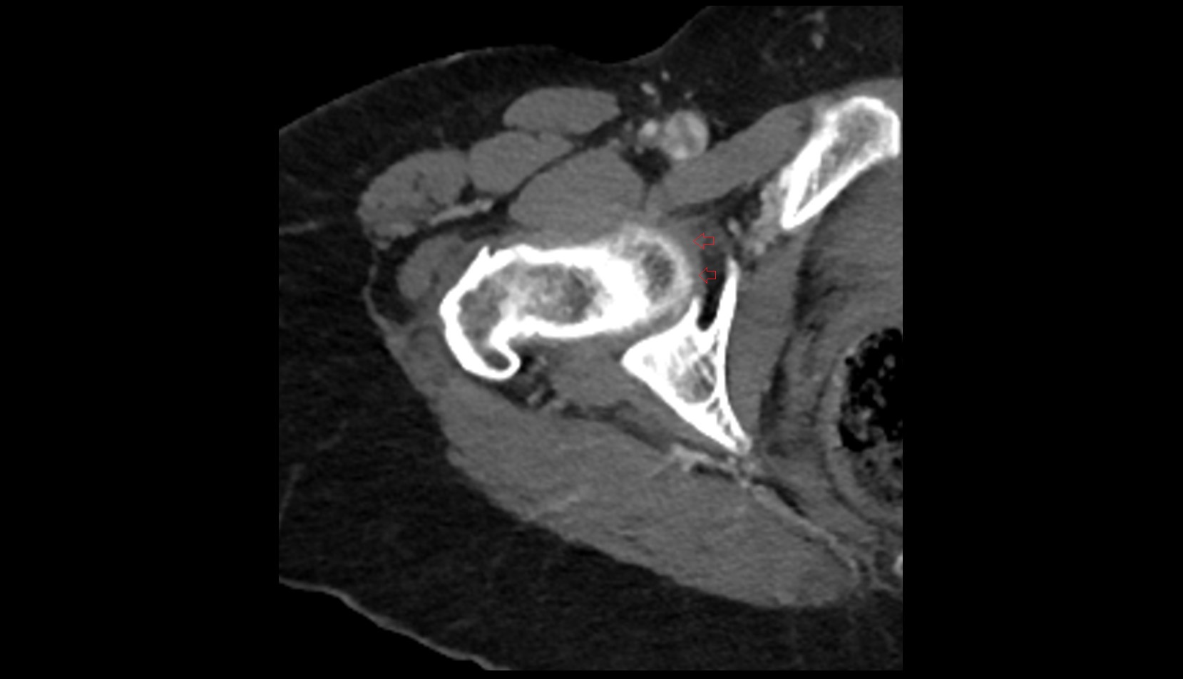 Transverse acetabular ligament ct axial image