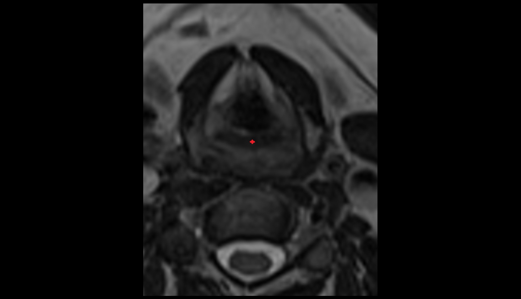 Transverse arytenoid muscle mri axial image
