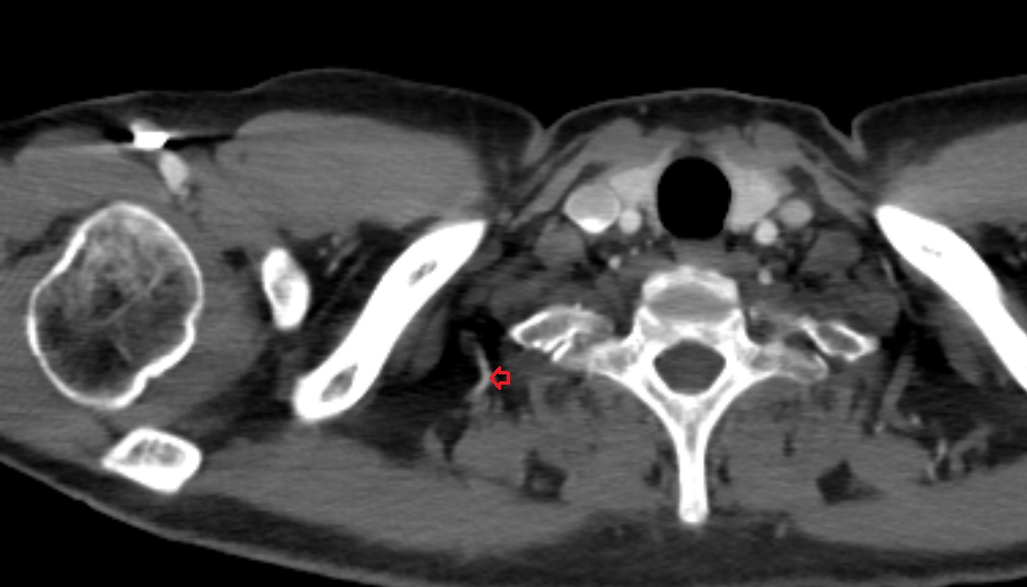 Transverse cervical artery  anatomy CT axial  image -img-00000-00000
