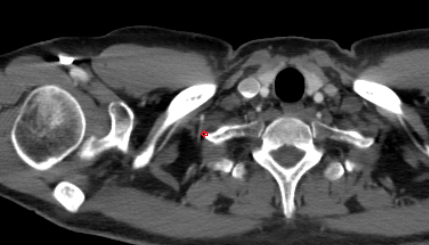 Transverse cervical artery  anatomy CT axial  image -img-00000-00000_00001