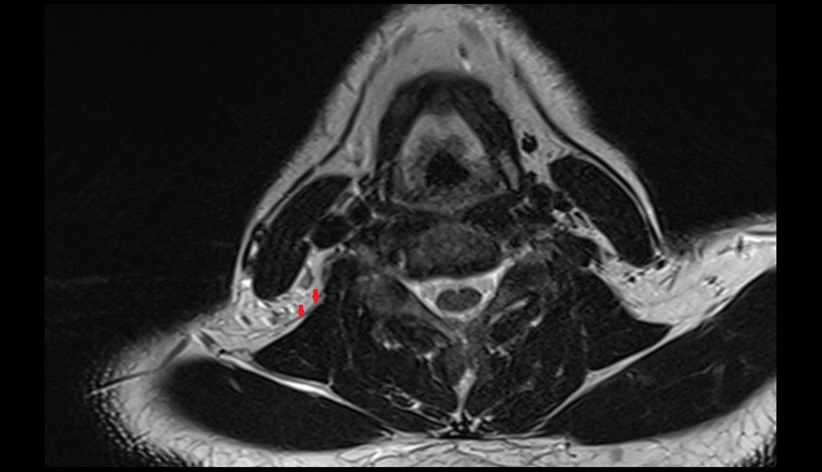 Transverse cervical artery axial image