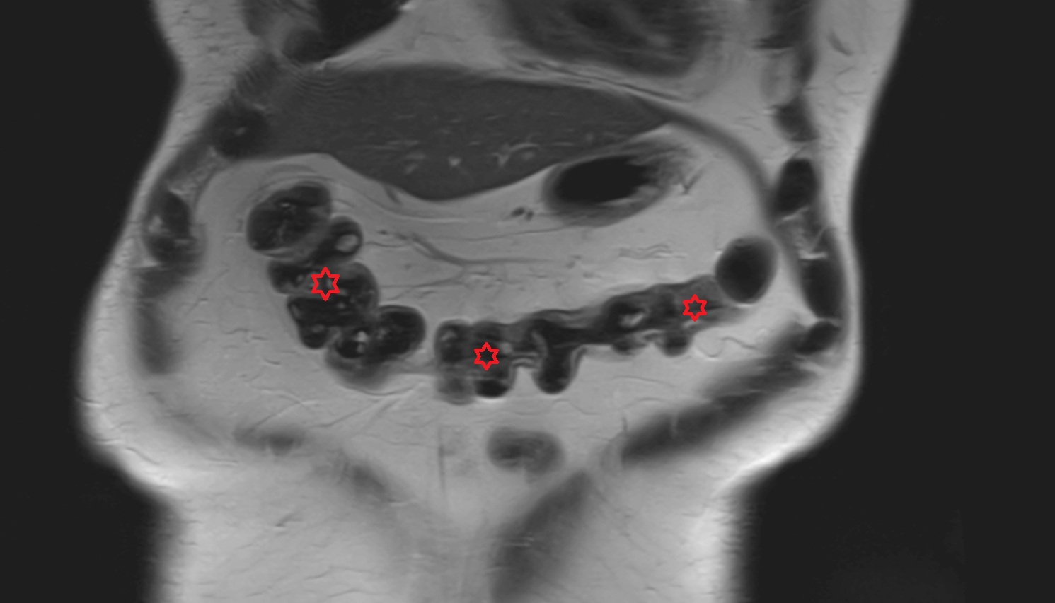 Transverse colon MRI coronal image anatomy  image -img-00000-00000