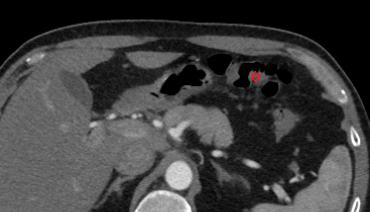 Transverse colon  anatomy  CT axial  image -img-00000-00000