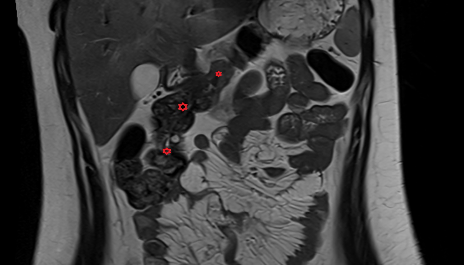 Transverse colon  anatomy  MRI coronal  image -img-00000-00000