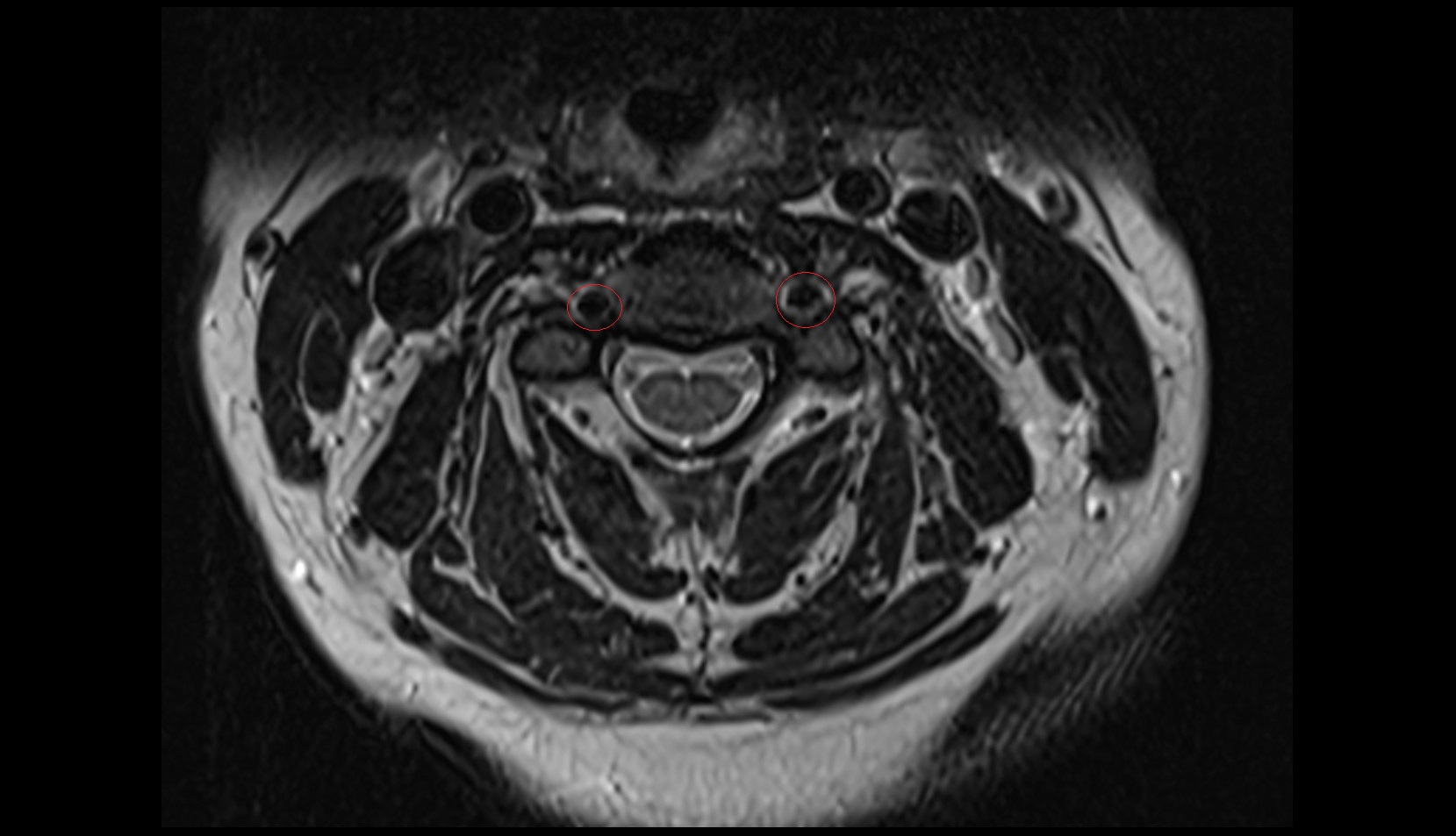Transverse foramen