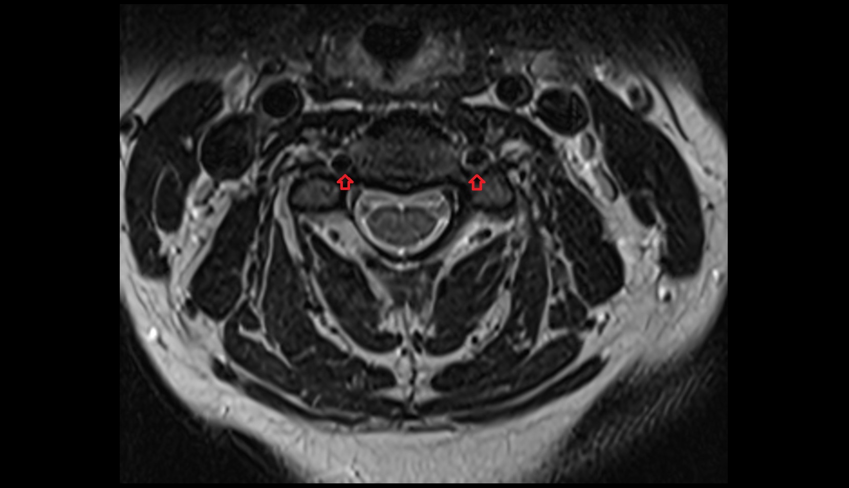 Transverse foramen mri axial image