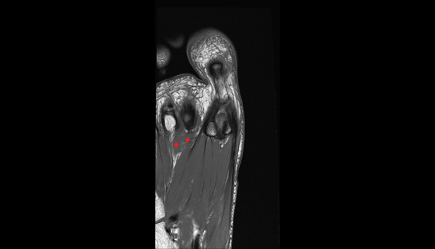 Transverse head of Adductor hallucis muscle axial cross sectional anatomy 3T MRI AI enhanced radiology image-img-00000-00000_00001