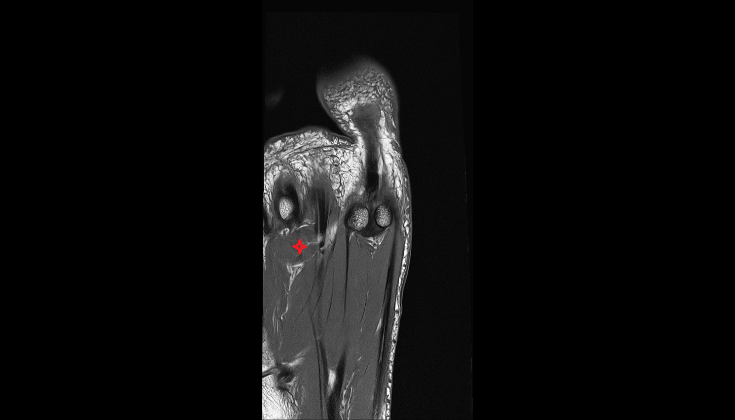 Transverse head of Adductor hallucis muscle axial cross sectional anatomy 3T MRI AI enhanced radiology image-img-00000-00000_00002