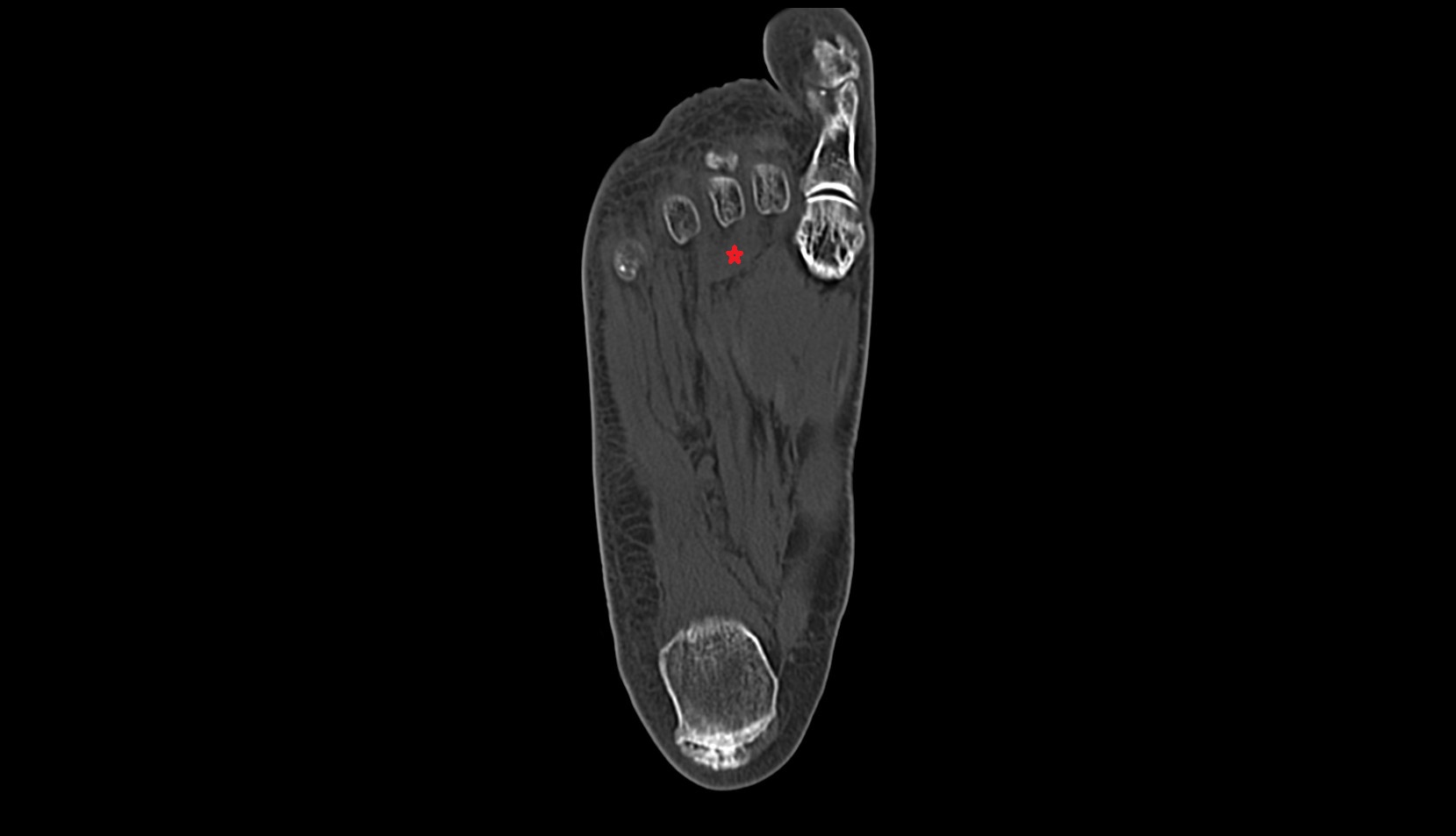 Transverse head of Adductor hallucis muscle  ct axial