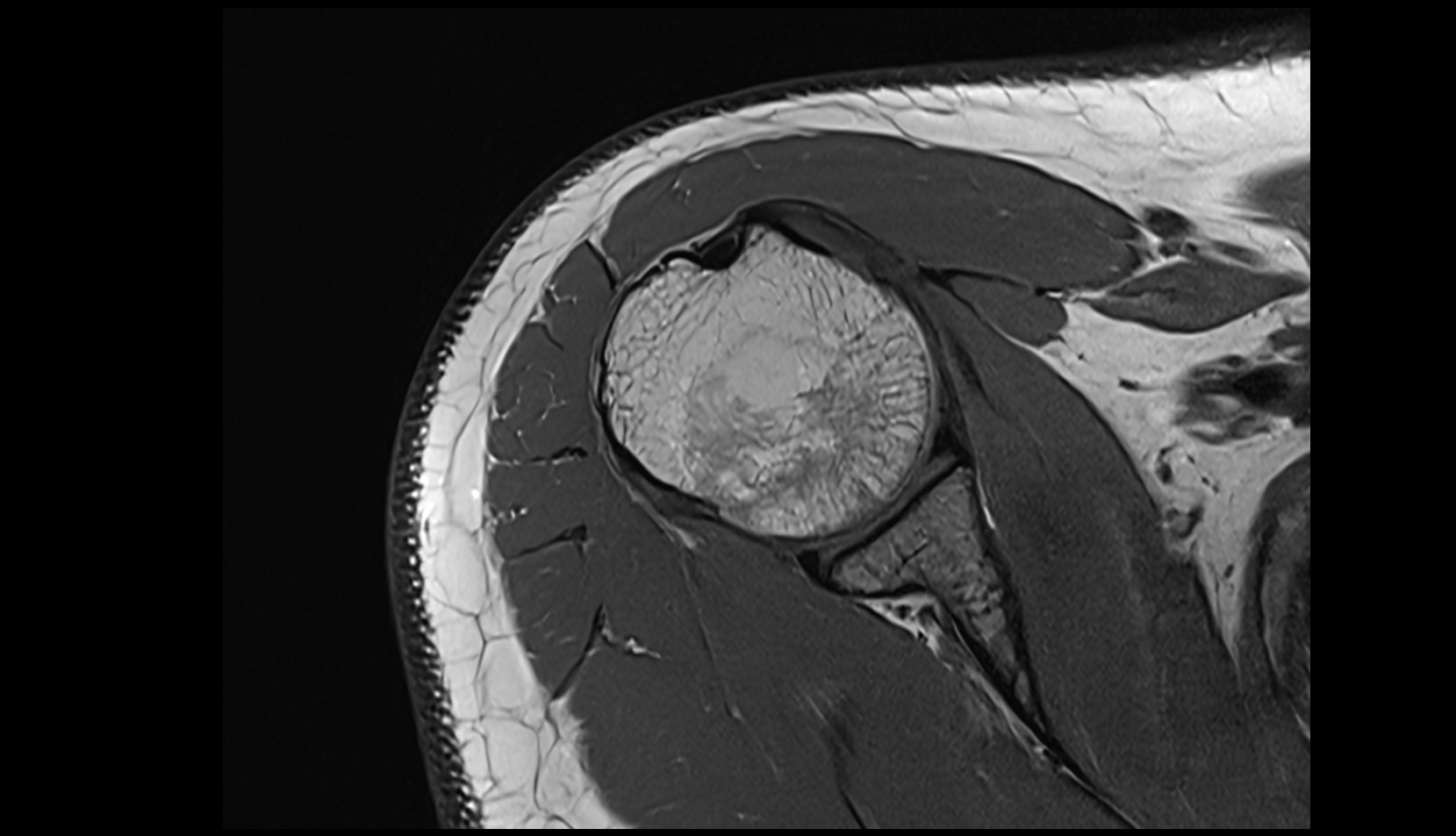 Transverse humeral ligament MRI 3T axial image