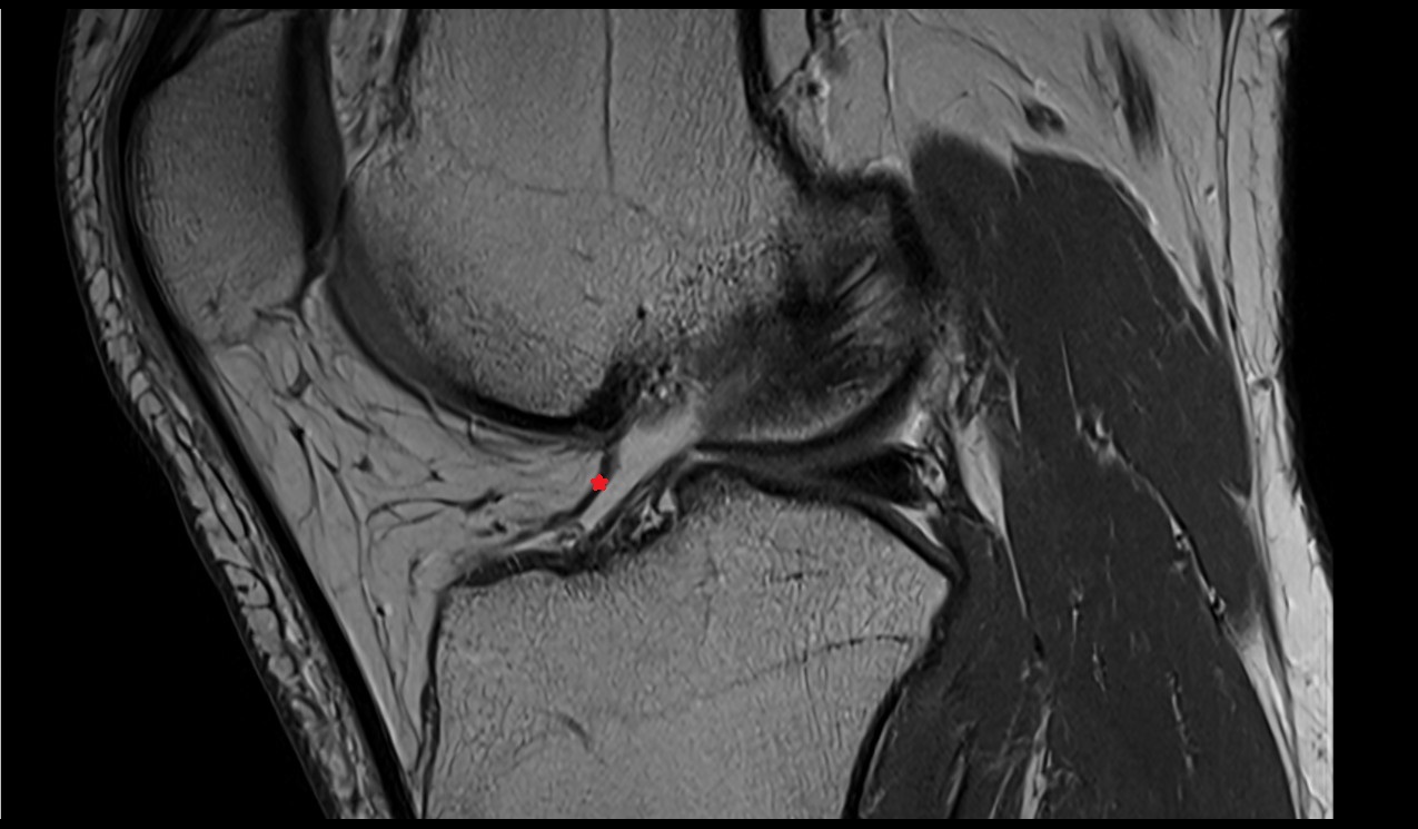 Transverse ligament of knee anatomy image