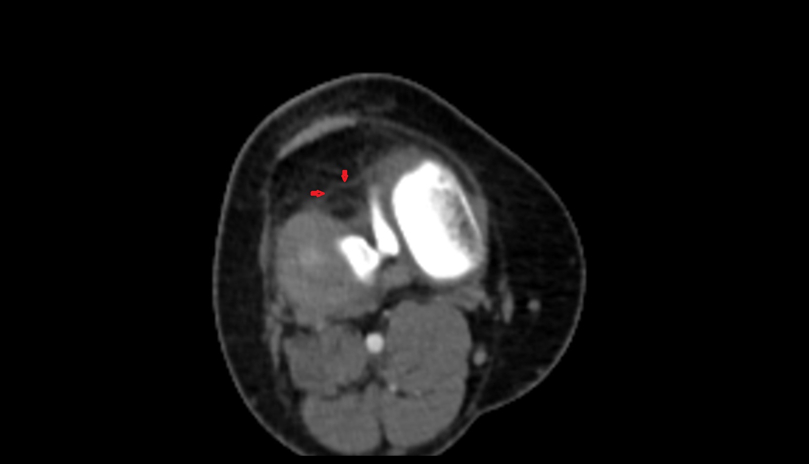 Transverse ligament of knee ct axial image