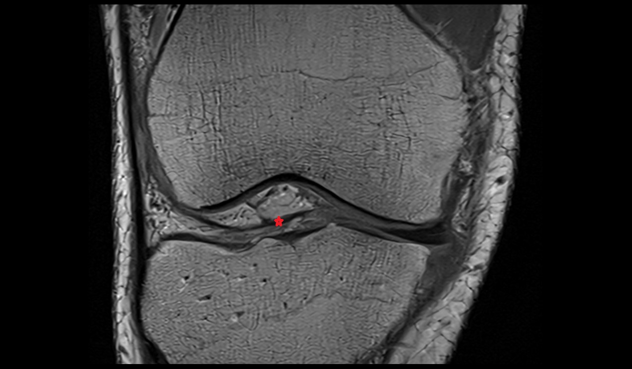 Transverse ligament of knee radiology anatomy image mri 3t