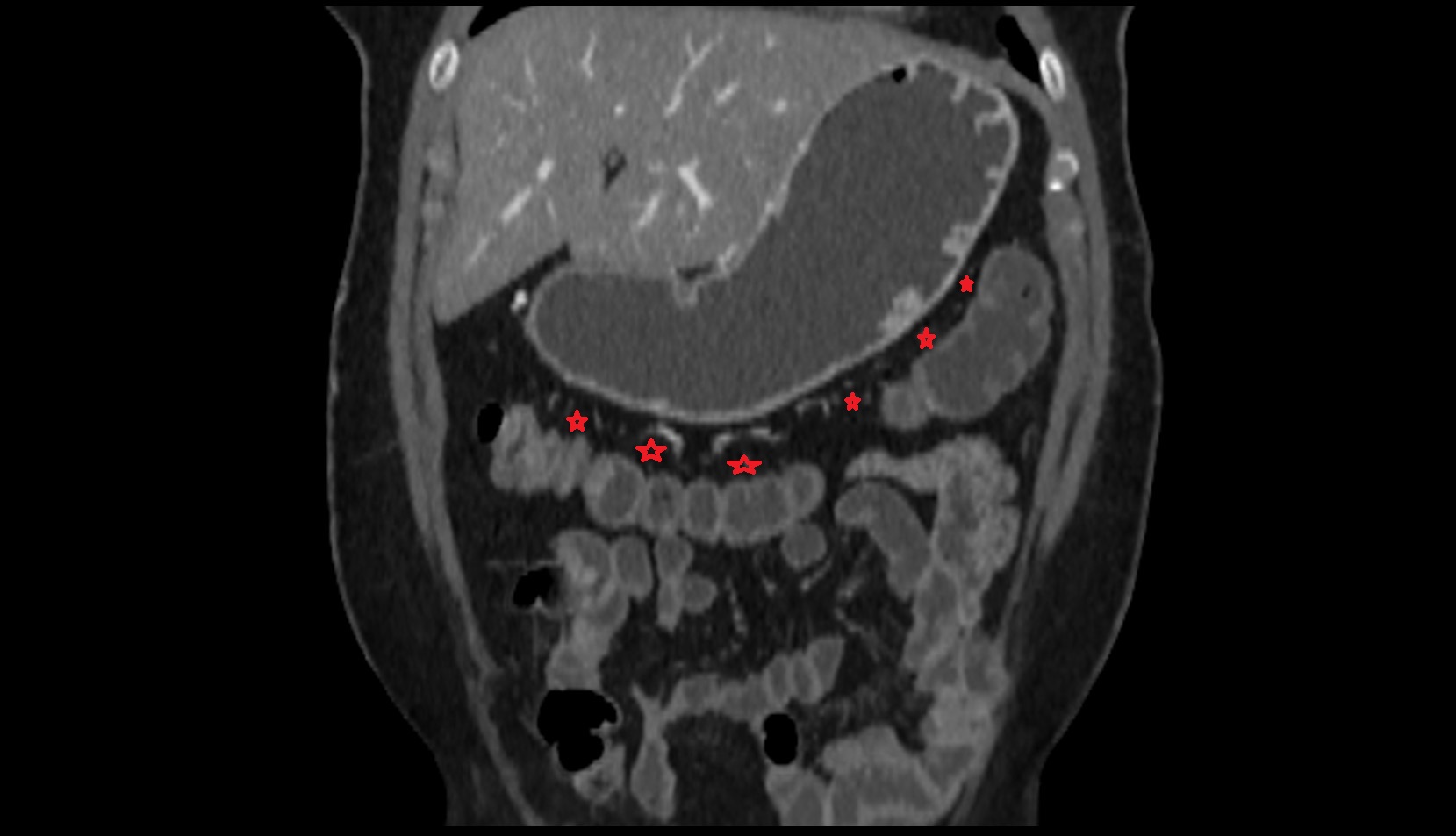 Transverse mesocolon CT coronal image