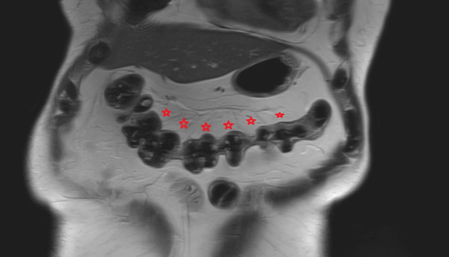 Transverse mesocolon  MRI coronal image anatomy  image -img-00000-00000