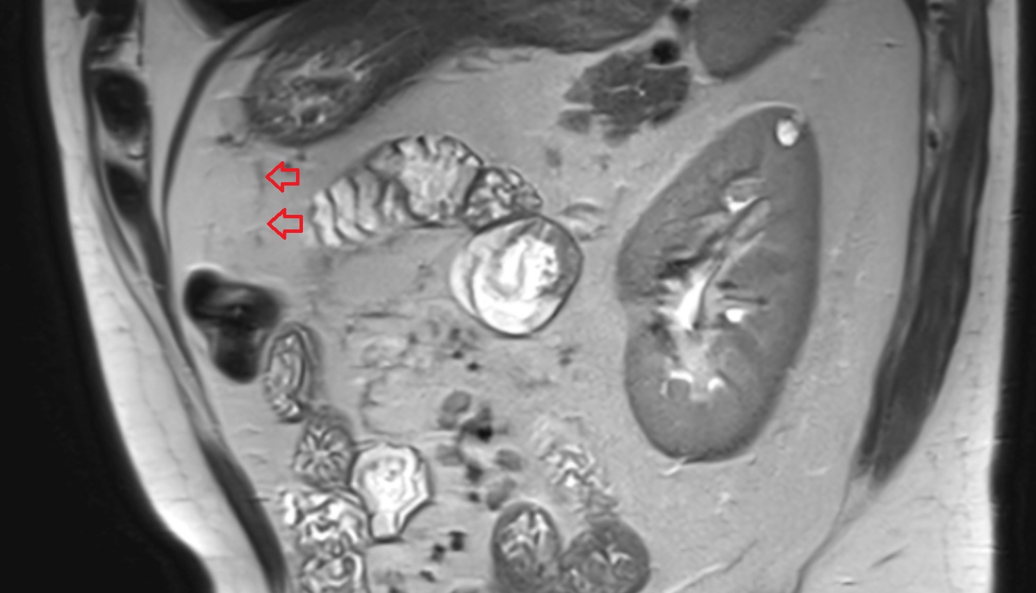 Transverse mesocolon  MRI sagittal image anatomy  image -img-00000-00000