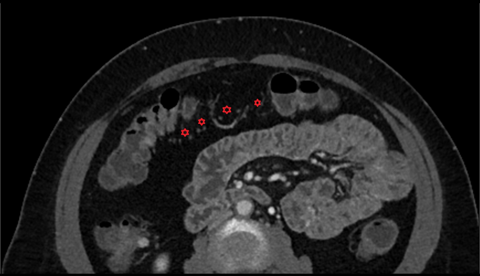 Transverse mesocolon axial ct image