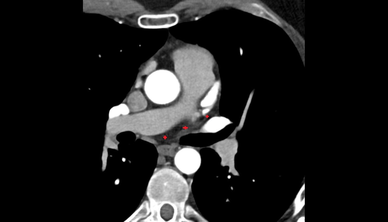 Transverse pericardial sinus  anatomy CT axial  image -img-00000-00000