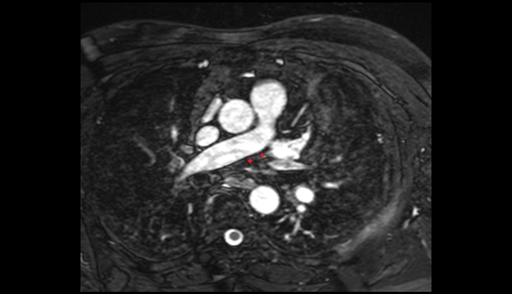 Transverse pericardial sinus mri image