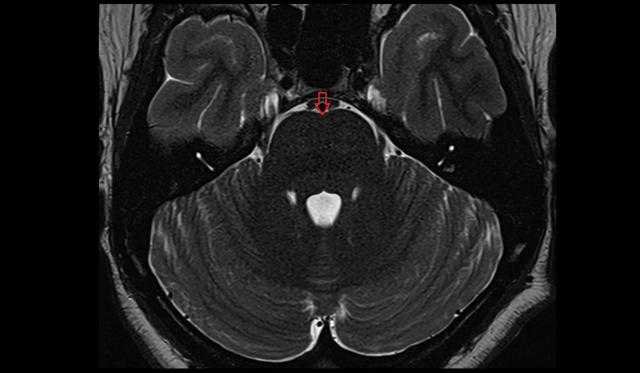 Transverse pontine fiber axial 3t mri image