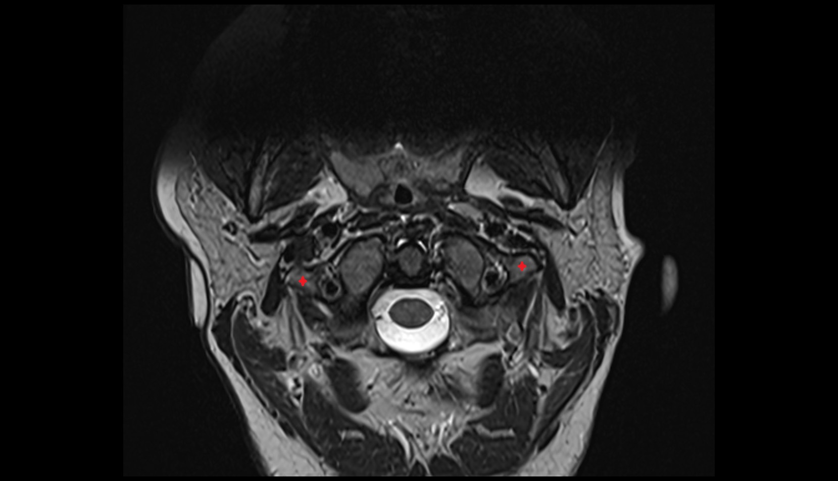 Transverse process of atlas