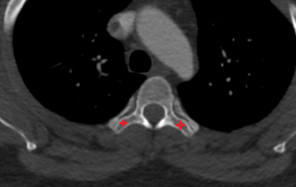 Transverse process of  vertebra , Location and Imaging Appearance  -img-00000-00000
