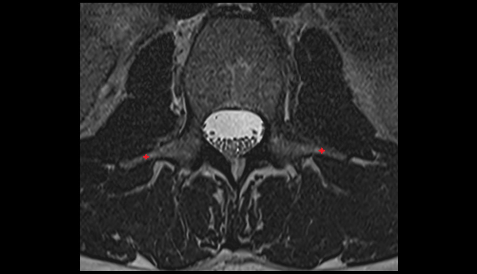 Transverse process of vertebra axial mri image
