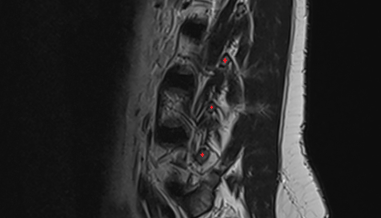 Transverse process of vertebra  mri sag  image -img-00000-00000