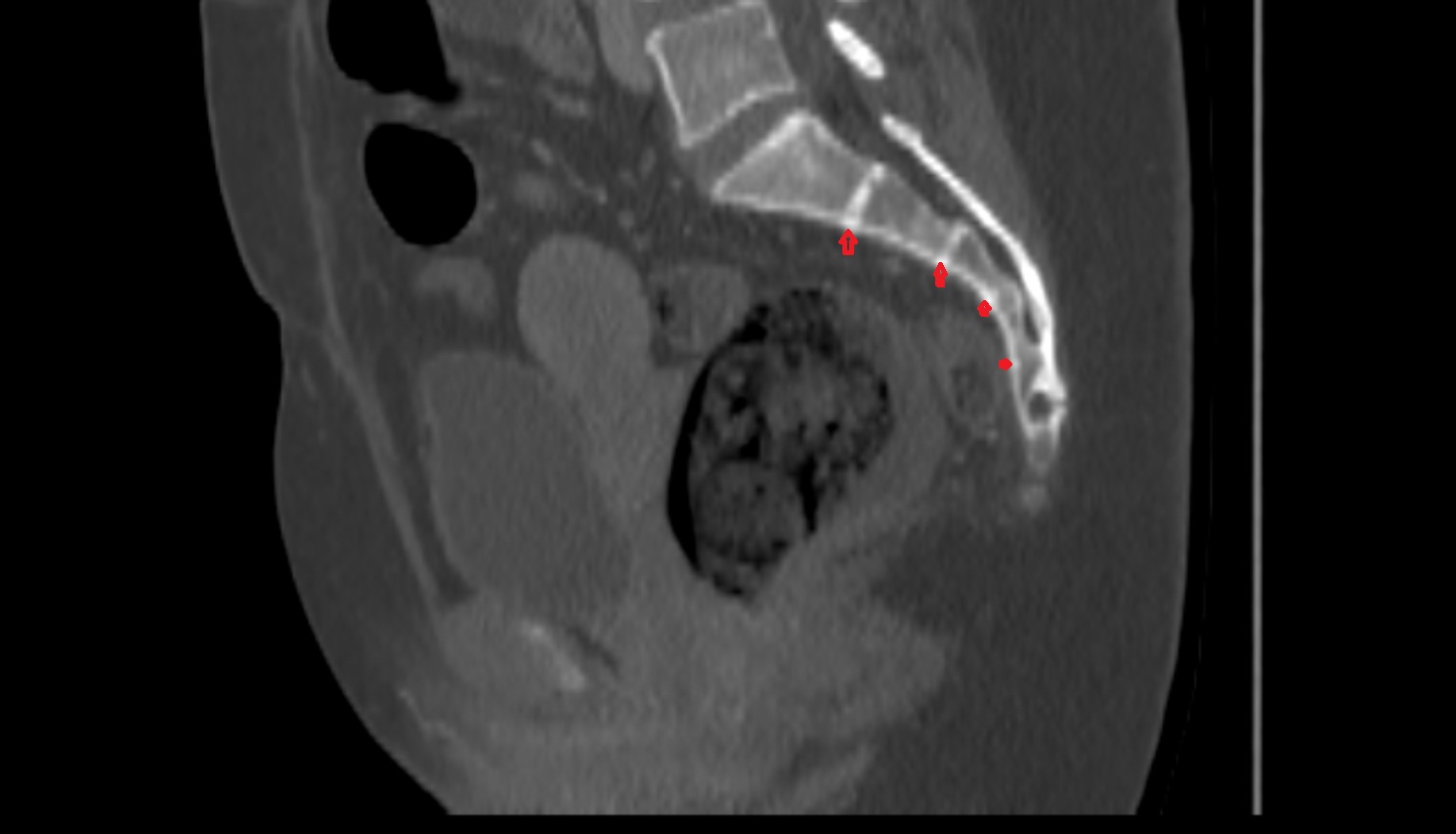 Transverse ridges  CT sag  anatomy  image-img-00000-00000