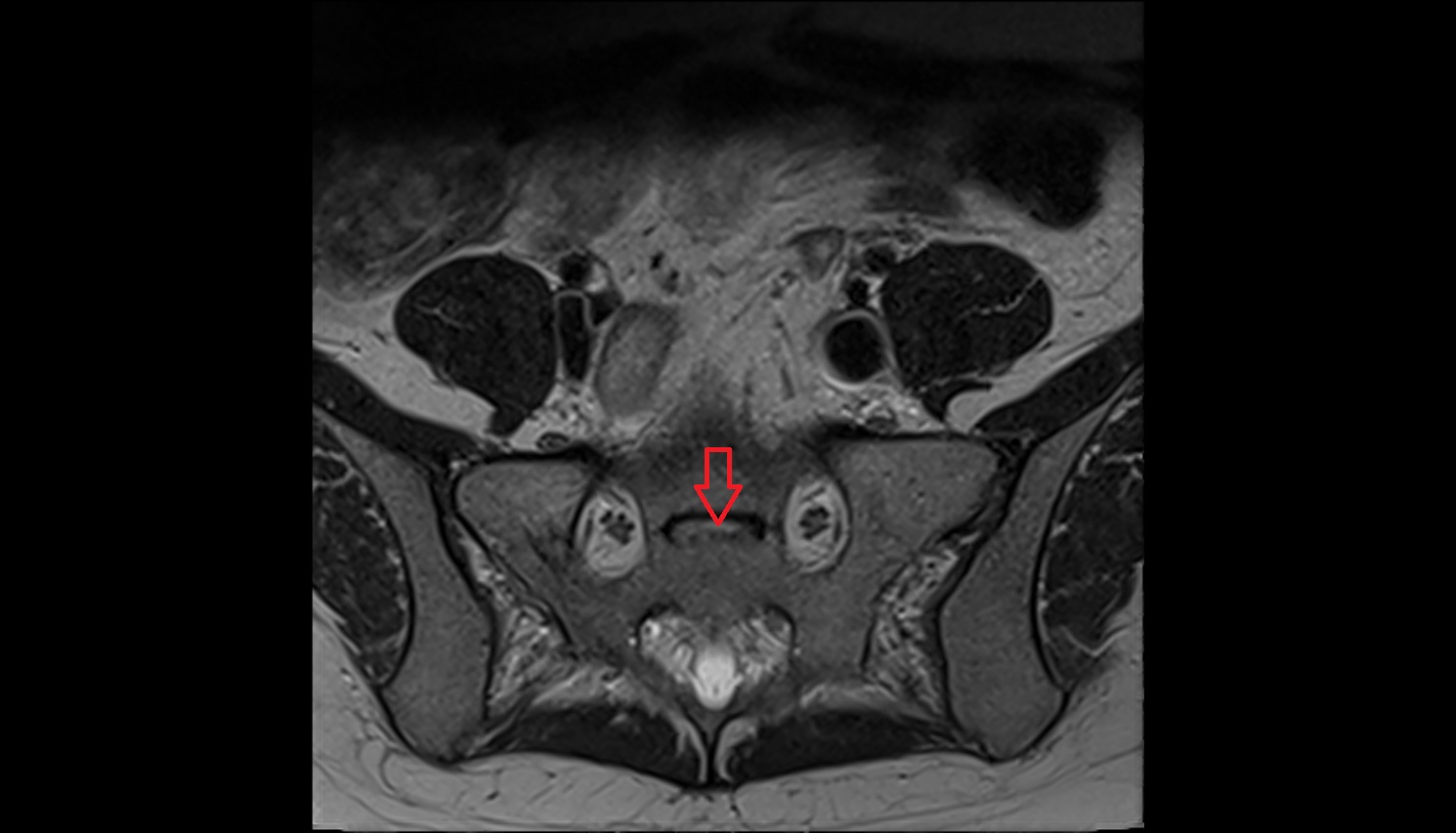 Transverse ridges  mri axial  anatomy  image-img-00000-00000