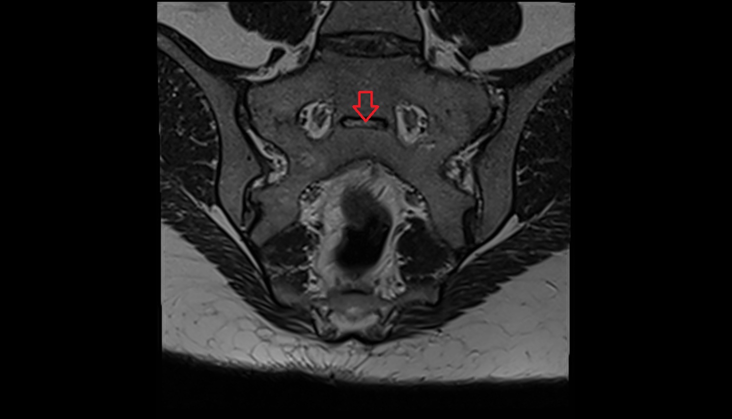 Transverse ridges  mri coronal  anatomy  image-img-00000-00000