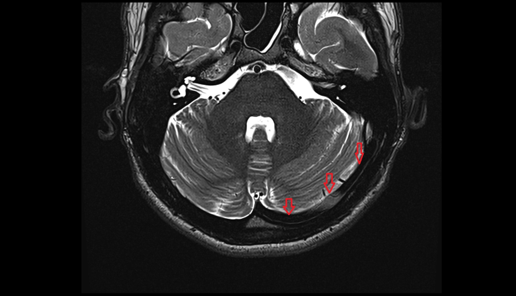 Transverse sinus MRI 3T axial image