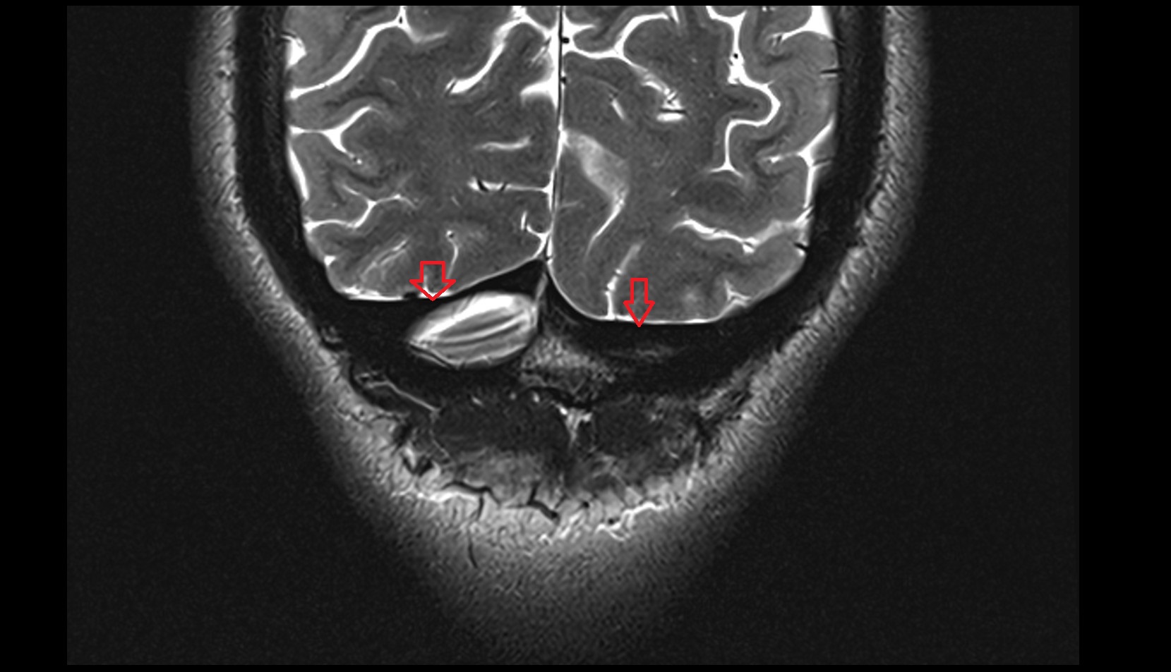 Transverse sinus MRI 3T coronal image