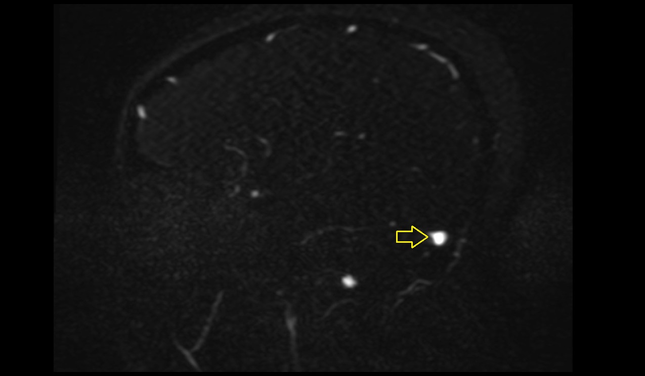 Transverse sinus MRI 3T sagittal image
