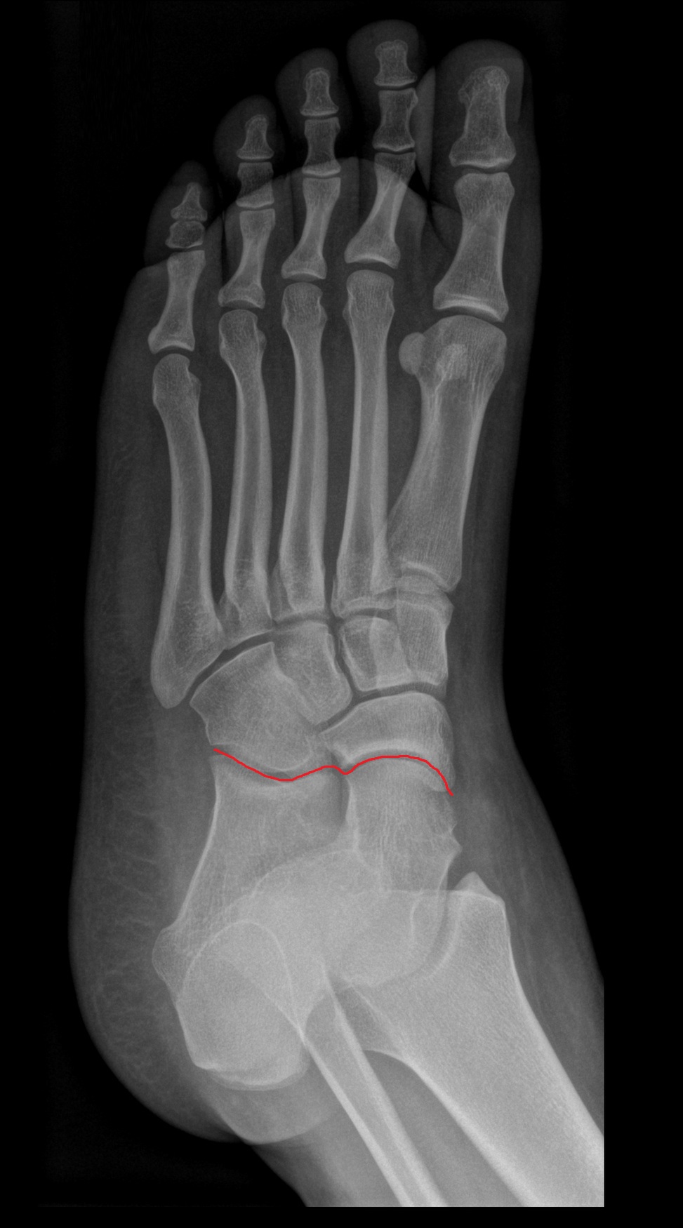Transverse tarsal joint