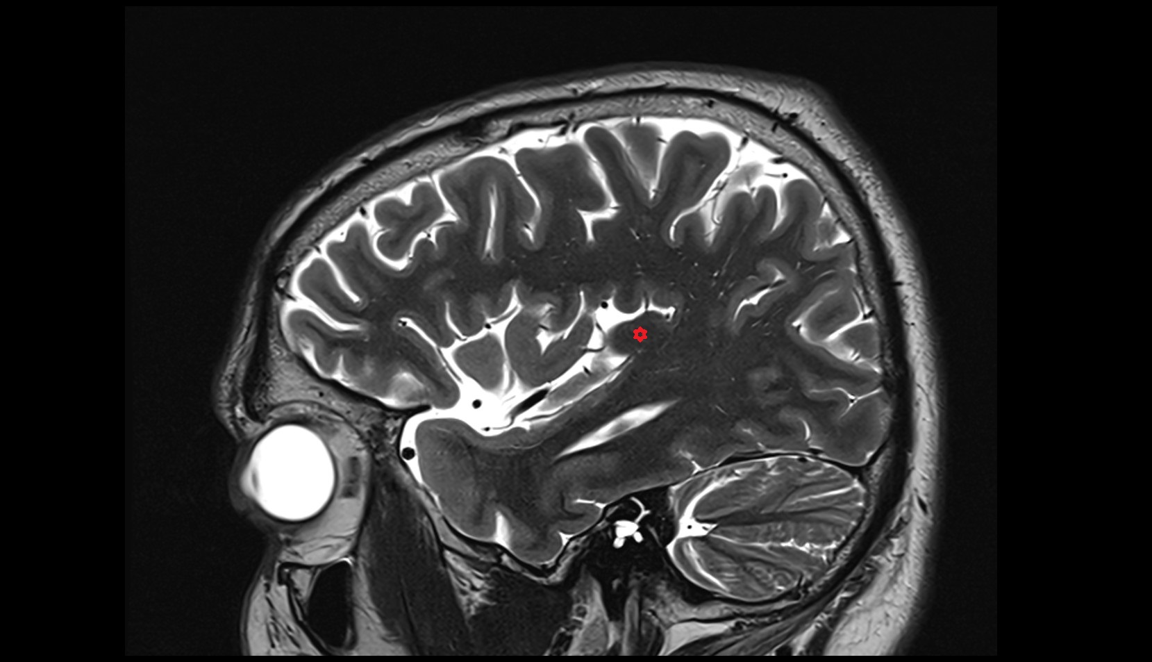 Transverse temporal gyri (Heschl) MRI 3T sagittal image